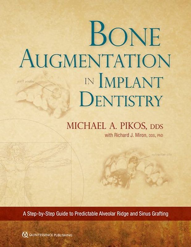 Bone Augmentation in Implant Dentistry