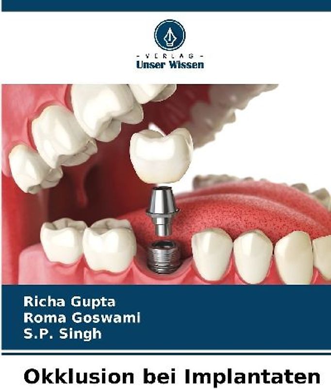 Okklusion bei Implantaten