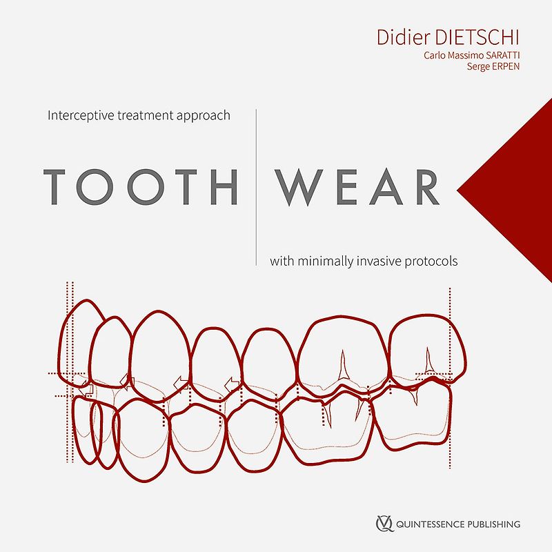 Tooth Wear