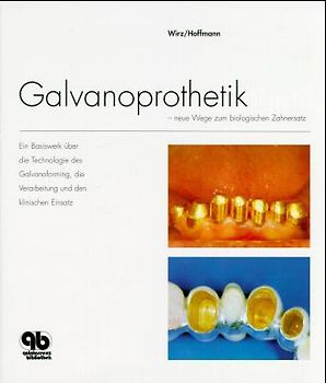 Galvanoprothetik