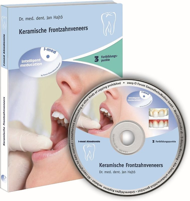 Keramische Frontzahnveneers