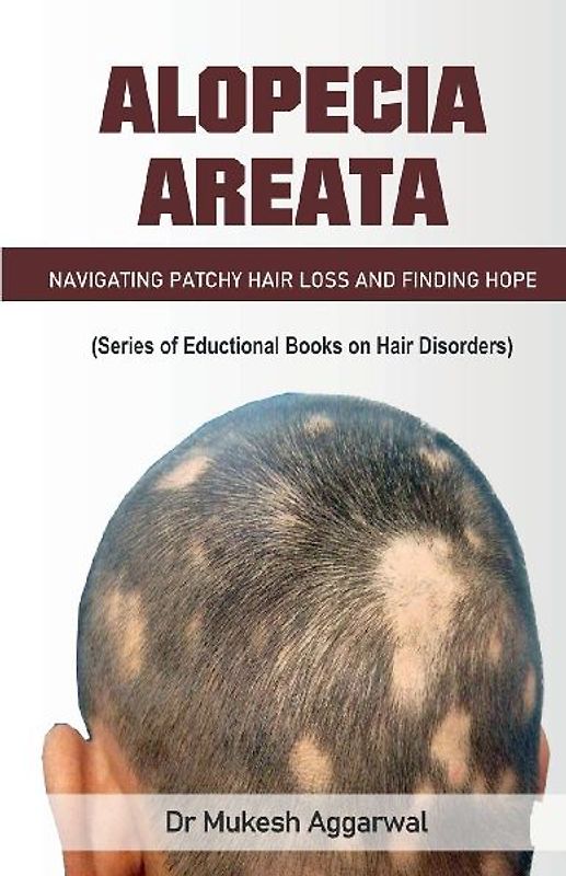 Alopecia Areata