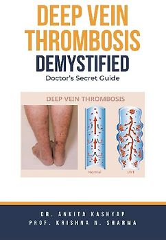 Deep Vein Thrombosis Demystified