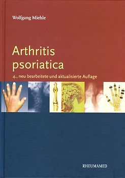 Arthritis psoriatica