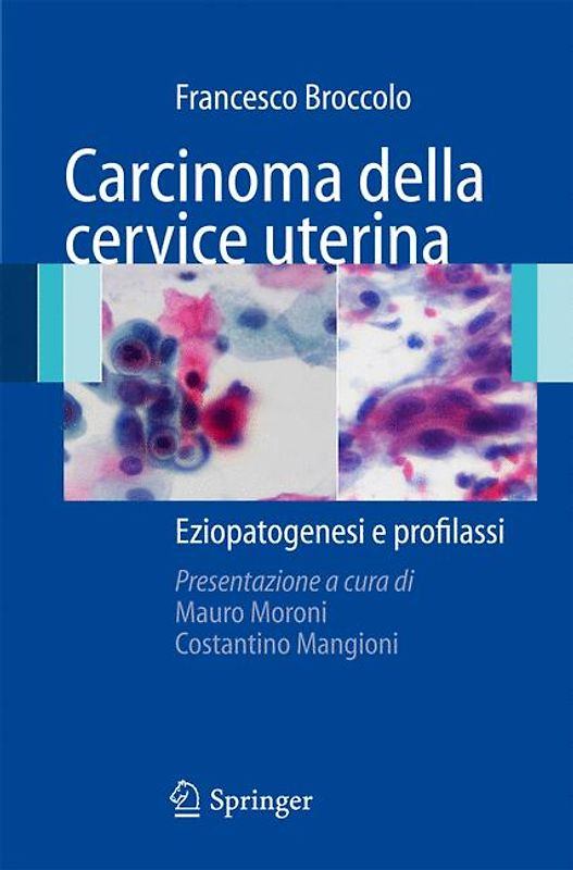 Carcinoma della cervice uterina