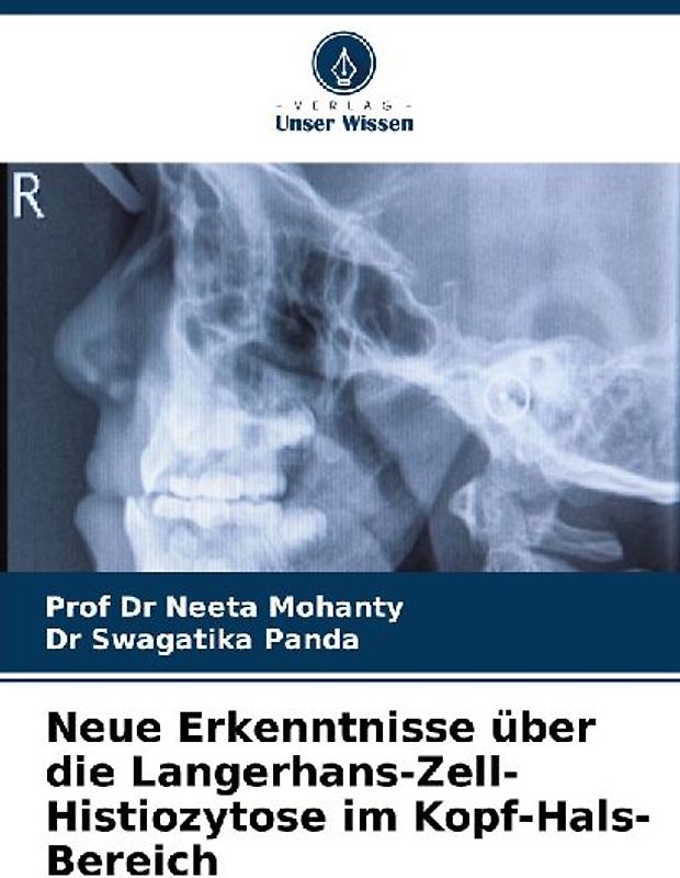 Neue Erkenntnisse über die Langerhans-Zell-Histiozytose im Kopf-Hals-Bereich