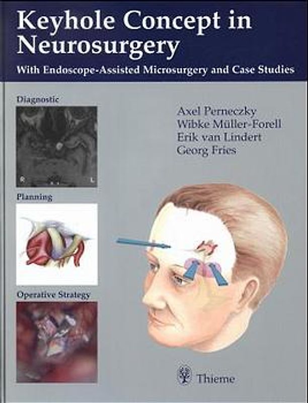 Keyhole Concept in Neurosurgery