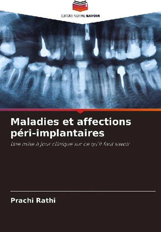 Maladies et affections péri-implantaires