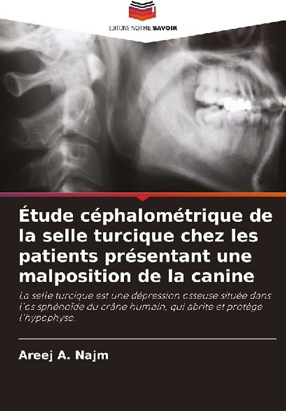 Étude céphalométrique de la selle turcique chez les patients présentant une malposition de la canine