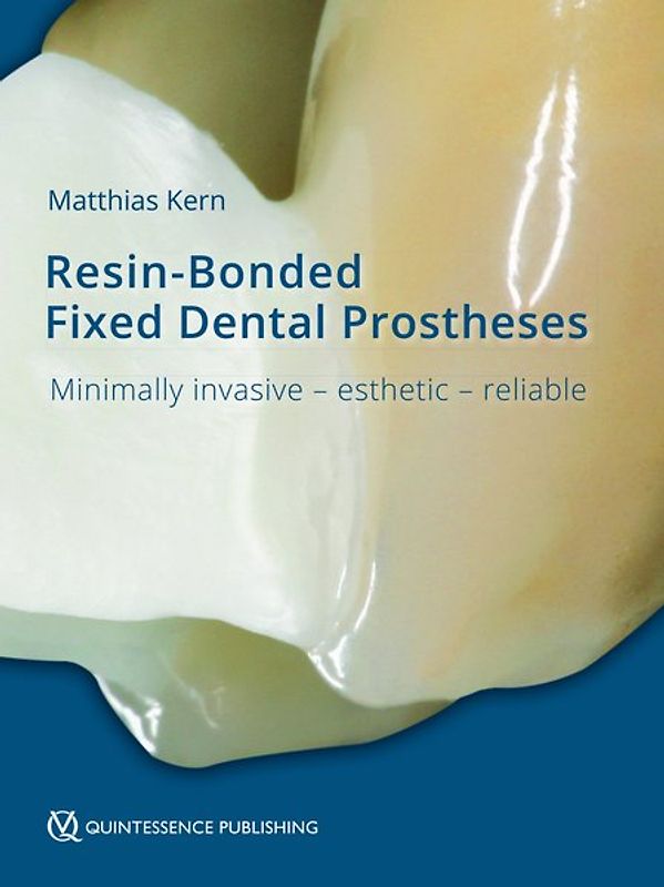 Resin-Bonded Fixed Dental Prostheses