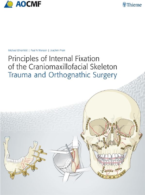 Principles of Internal Fixation of the Craniomaxillofacial Skeleton