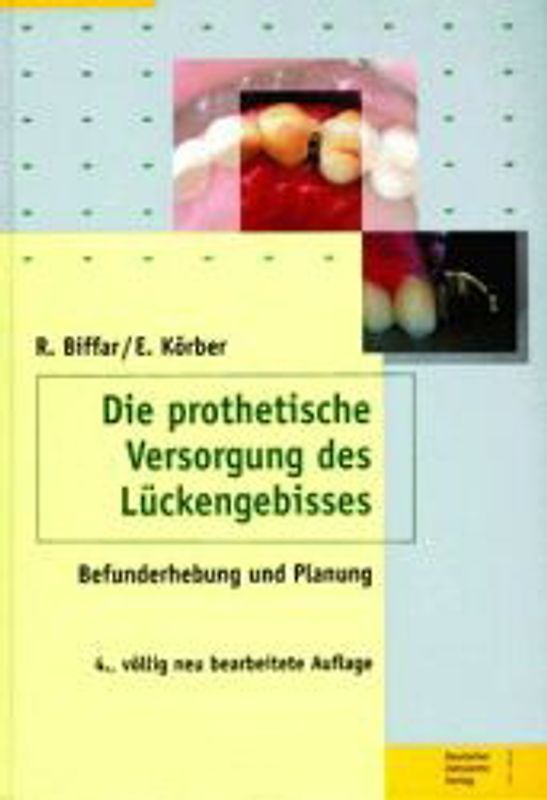 Die prothetische Versorgung des Lückengebisses