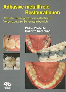 Adhäsive metallfreie Restaurationen