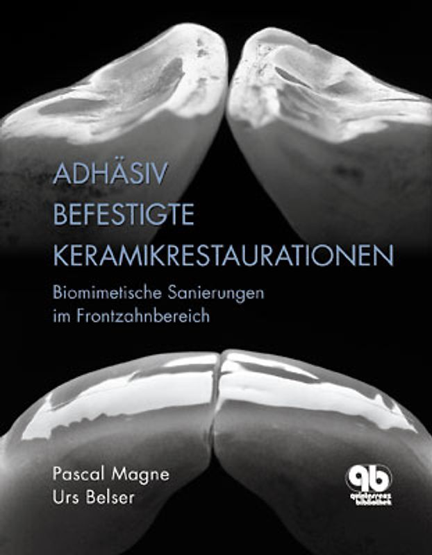 Adhäsiv befestigte Keramikrestaurationen