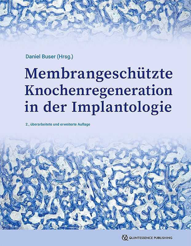 GBR-Technik in der Implantologie