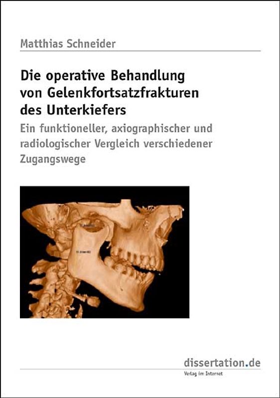 Die operative Behandlung von Gelenkfortsatzfrakturen des Unterkiefers