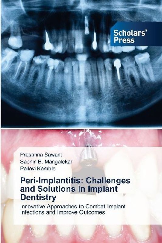 Peri-Implantitis: Challenges and Solutions in Implant Dentistry