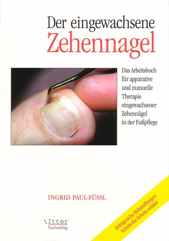 Der eingewachsene Zehennagel