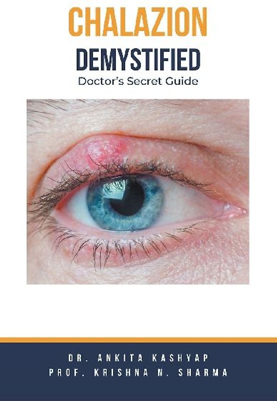 Chalazion Demystified