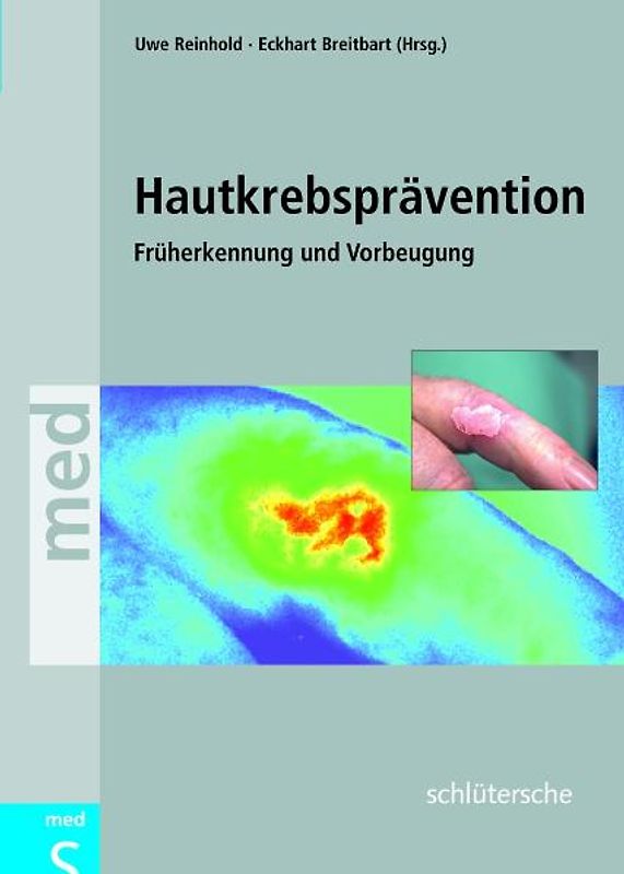 Hautkrebsprävention