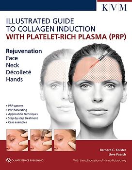 Illustrated Guide to Collagen Induction with Platelet-Rich Plasma (PRP)
