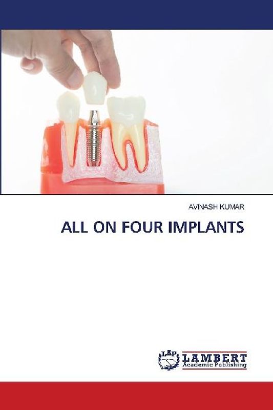 ALL ON FOUR IMPLANTS