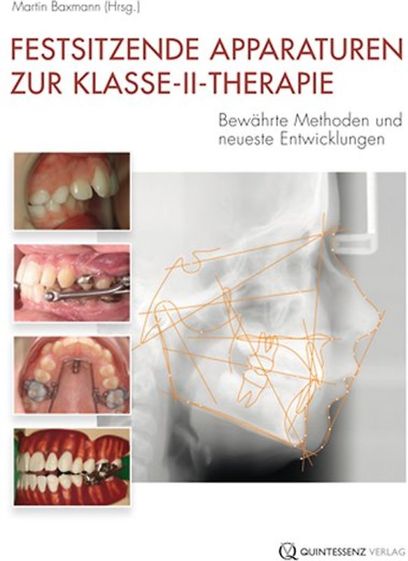 Festsitzende Apparaturen zur Klasse-II-Therapie