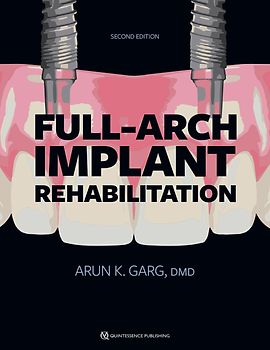 Full-Arch Implant Rehabilitation