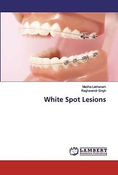 White Spot Lesions