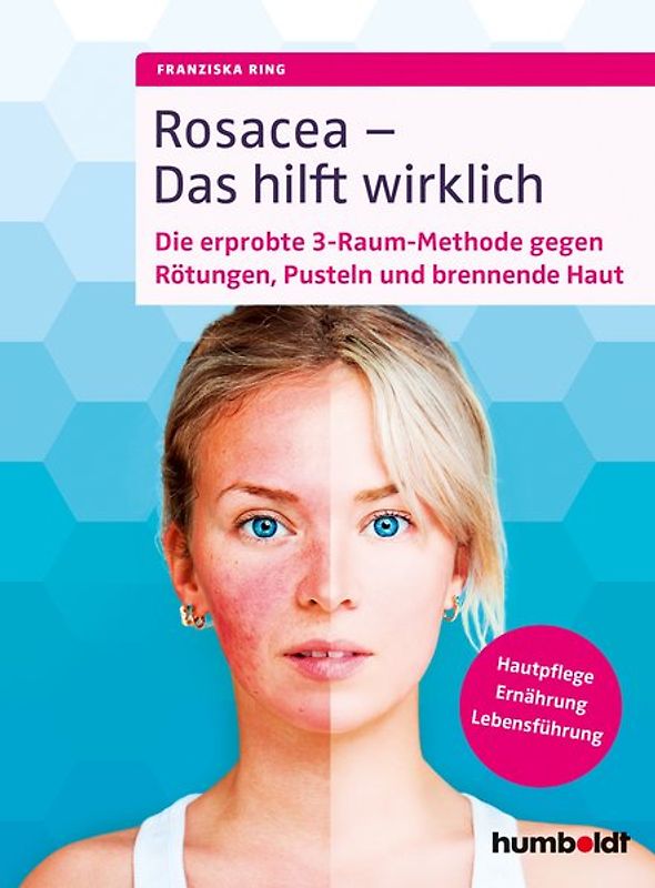 Rosacea – Das hilft wirklich