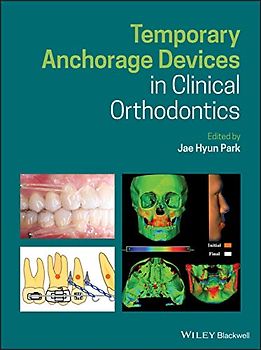 Temporary Anchorage Devices in Clinical Orthodontics