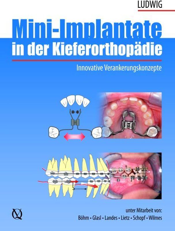 Mini-Implantate in der Kieferorthopädie