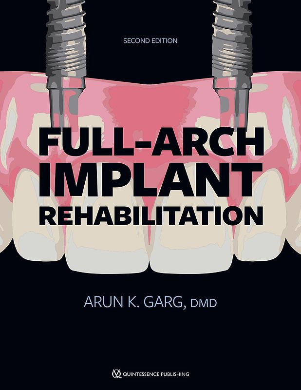 Full-Arch Implant Rehabilitation