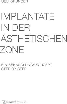 Implantate in der ästhetischen Zone