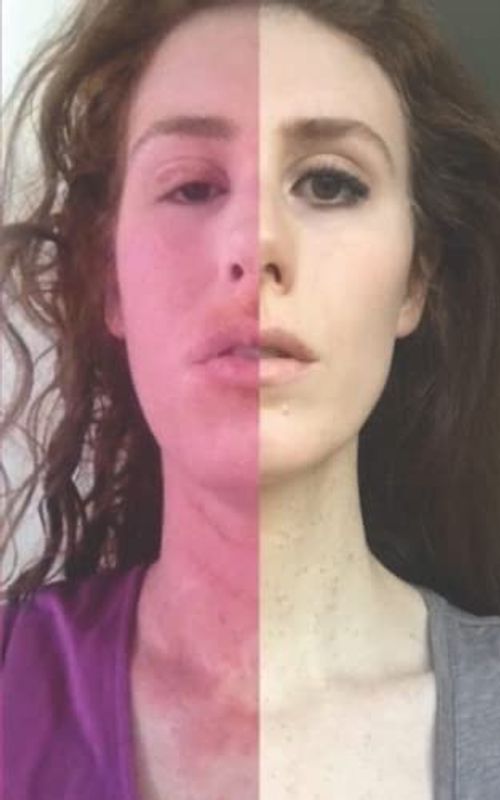 Curing my Incurable Eczema: My Topical Steroid Withdrawal (TSW) Journey