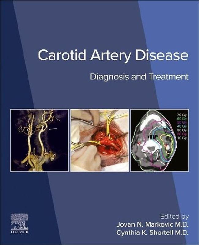 Carotid Artery Disease