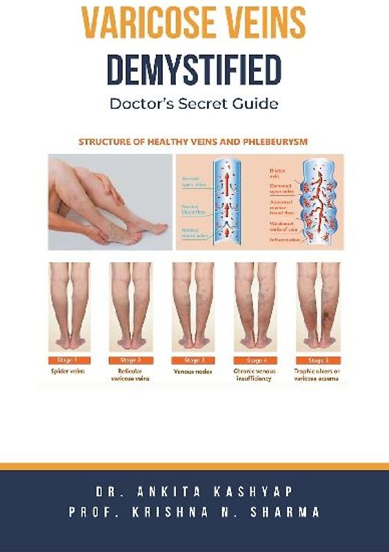 Varicose Veins Demystified