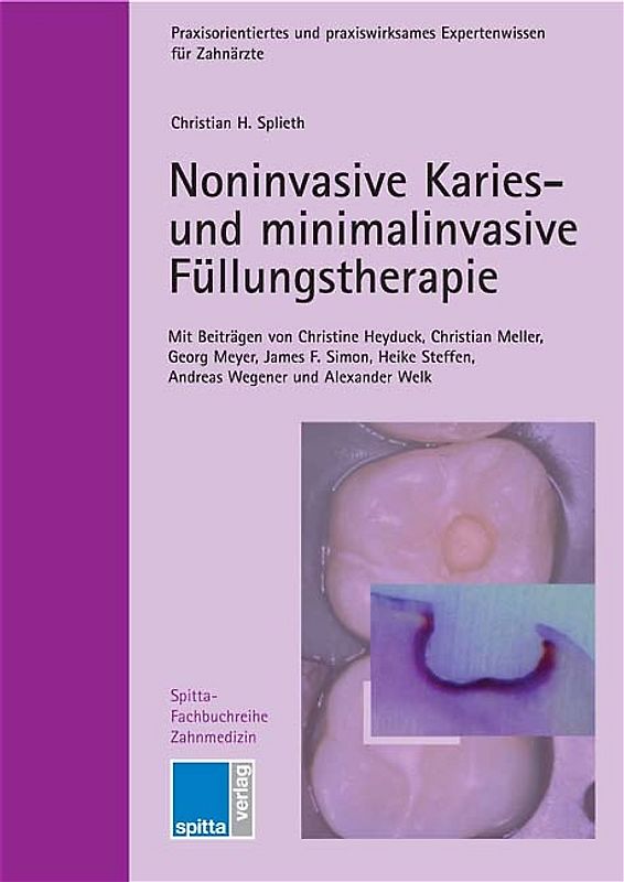 Noninvasive Karies- und minimalinvasive Füllungstherapie