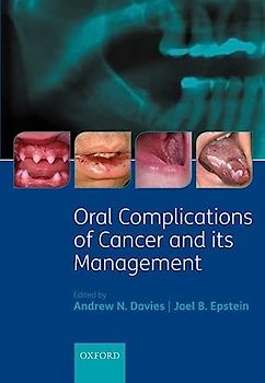 Oral Complications of Cancer and Its Management