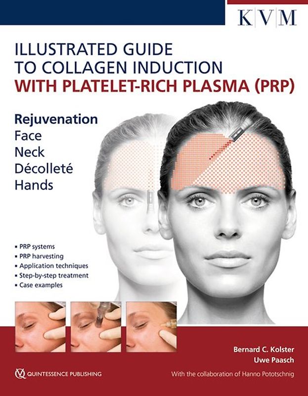 Illustrated Guide to Collagen Induction with Platelet-Rich Plasma (PRP)