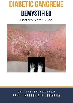 Diabetic Gangrene Demystified