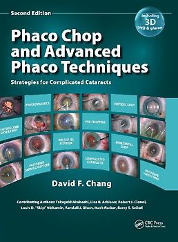 Phaco Chop and Advanced Phaco Techniques