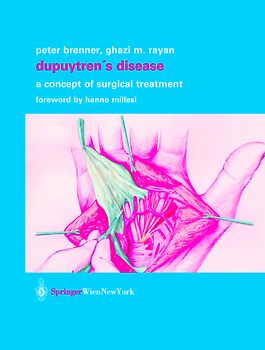 Dupuytren’s Disease