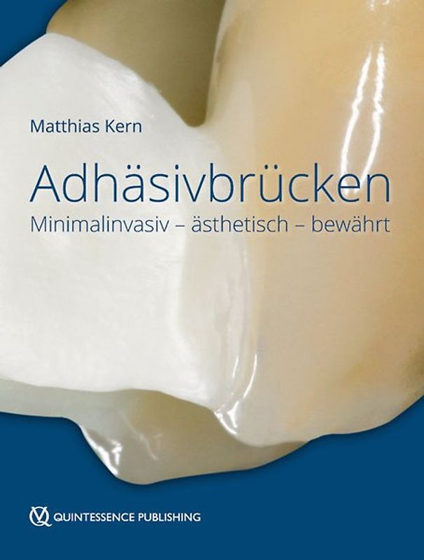 Adhäsivbrücken