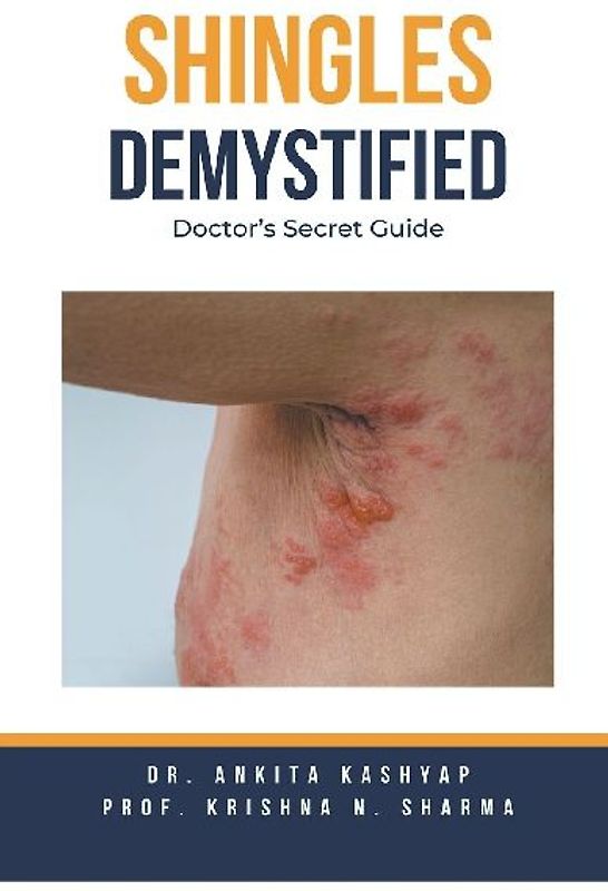 Shingles Demystified