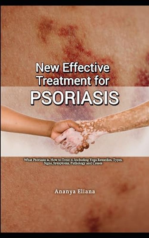 New Effective Treatment for Psoriasis: What Psoriasis is, How to Treat it, Including Yoga Remedies, Types, Signs, Symptoms, Pathology and Causes