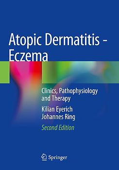 Atopic Dermatitis - Eczema