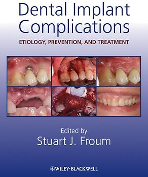 Dental Implant Complications