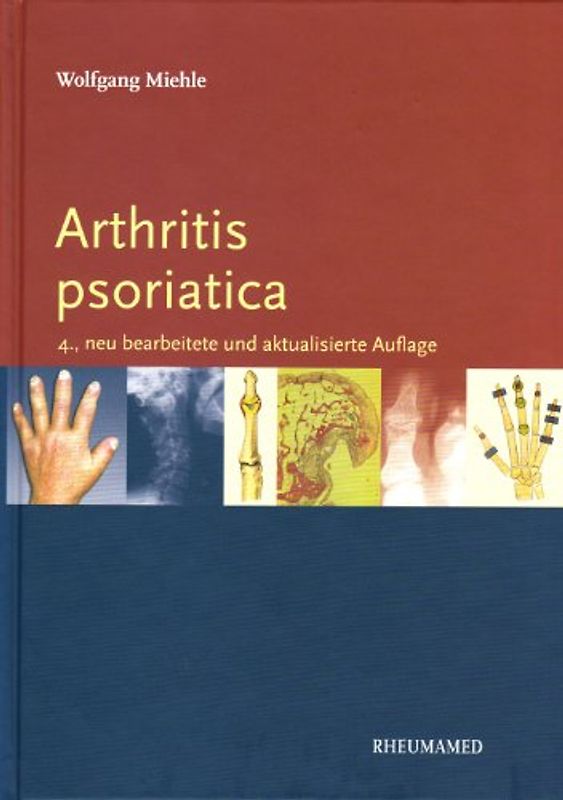 Arthritis psoriatica