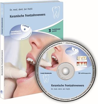 Keramische Frontzahnveneers